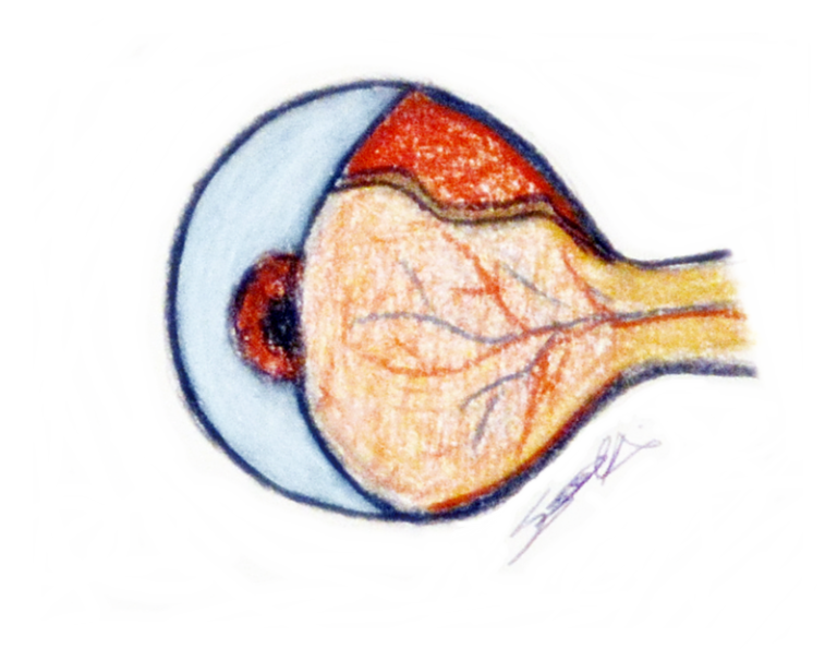 Read more about the article Retinal detachment