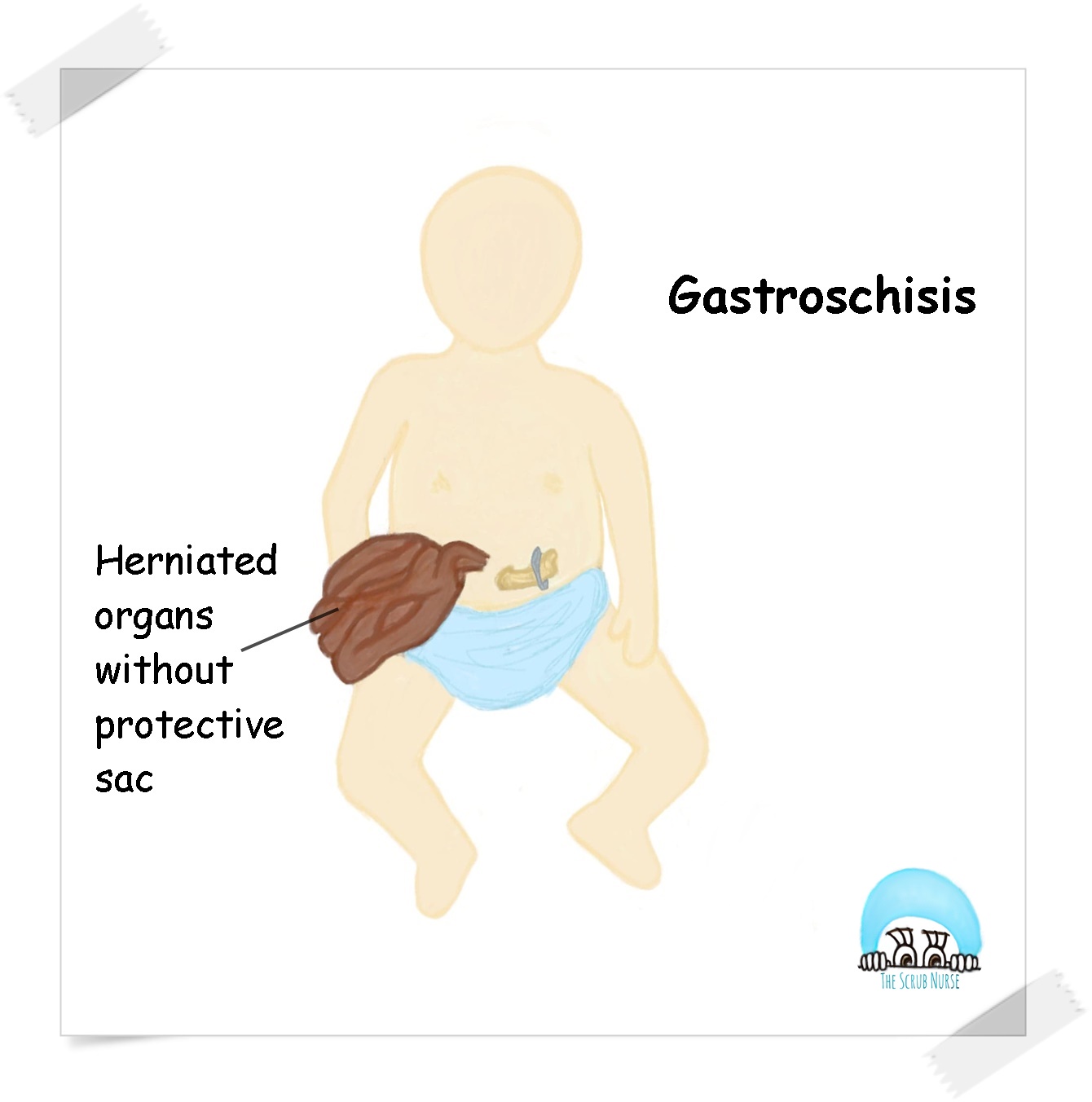 Gastroschisis vs Omphalocele (Exomphalos) - The Scrub Nurse