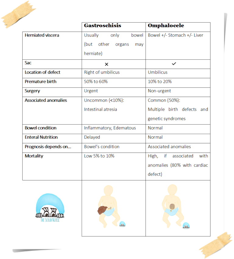 Gastroschisis vs Omphalocele (Exomphalos) - The Scrub Nurse