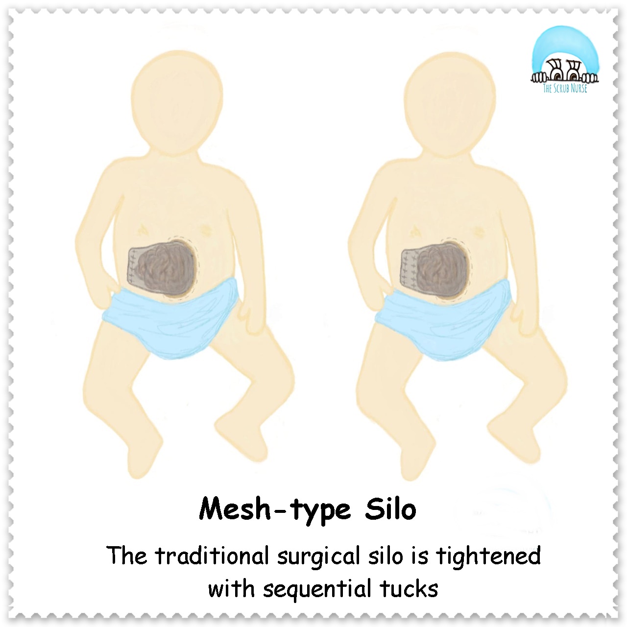 Gastroschisis Vs Omphalocele (Exomphalos) - The Scrub Nurse