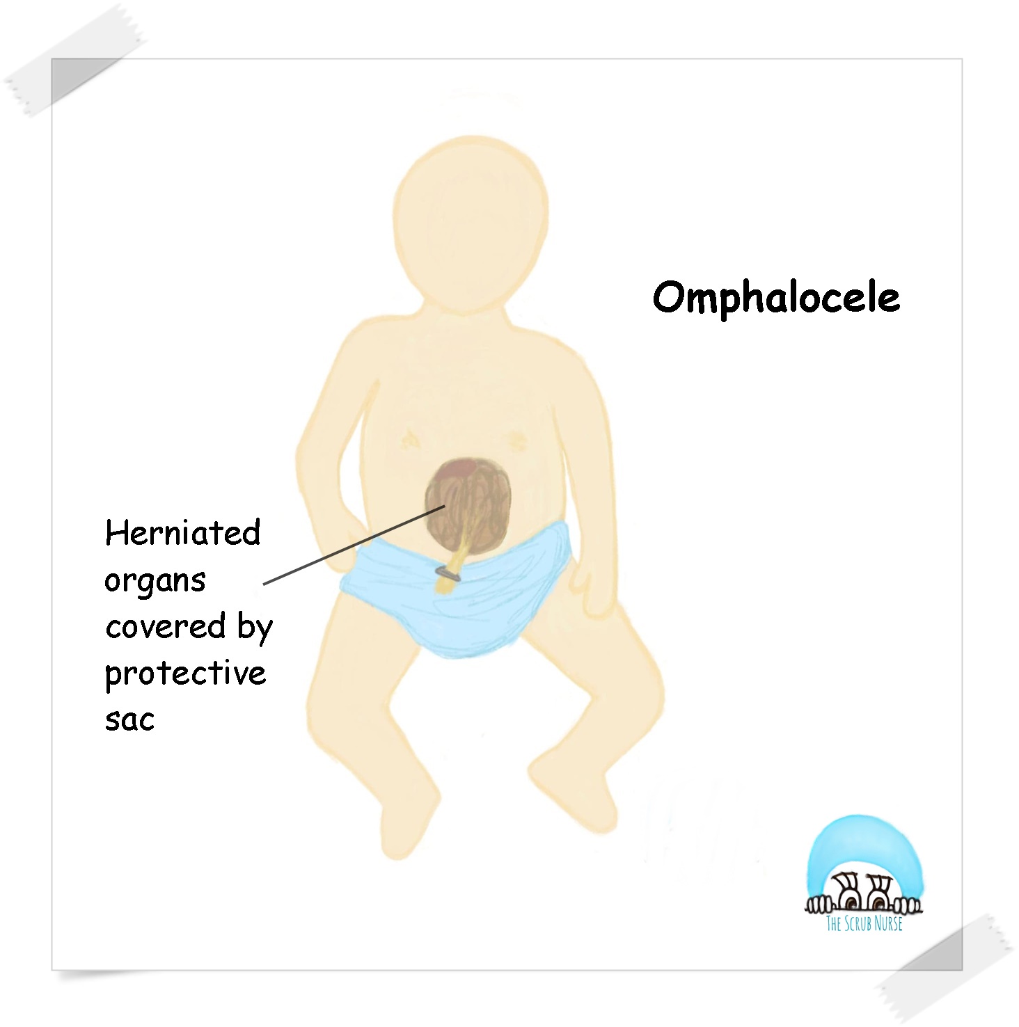 Gastroschisis Vs Omphalocele (Exomphalos) - The Scrub Nurse