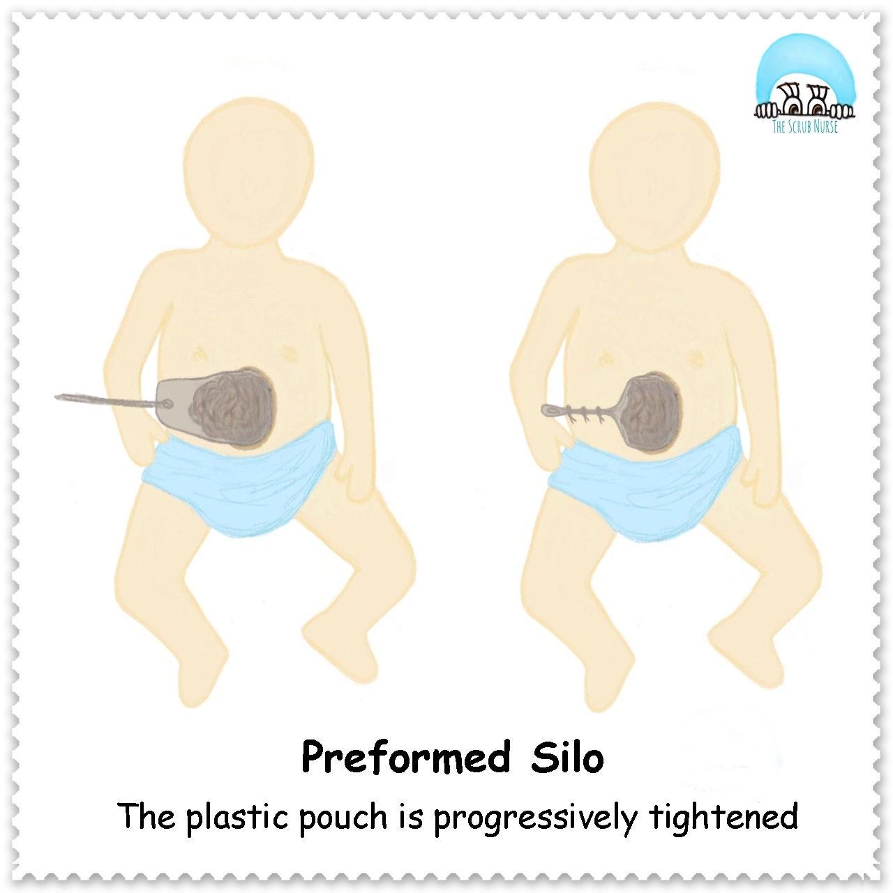 Gastroschisis Vs Omphalocele (Exomphalos) - The Scrub Nurse