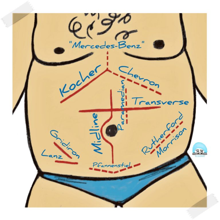 Read more about the article Abdominal incisions: the names and anatomical locations