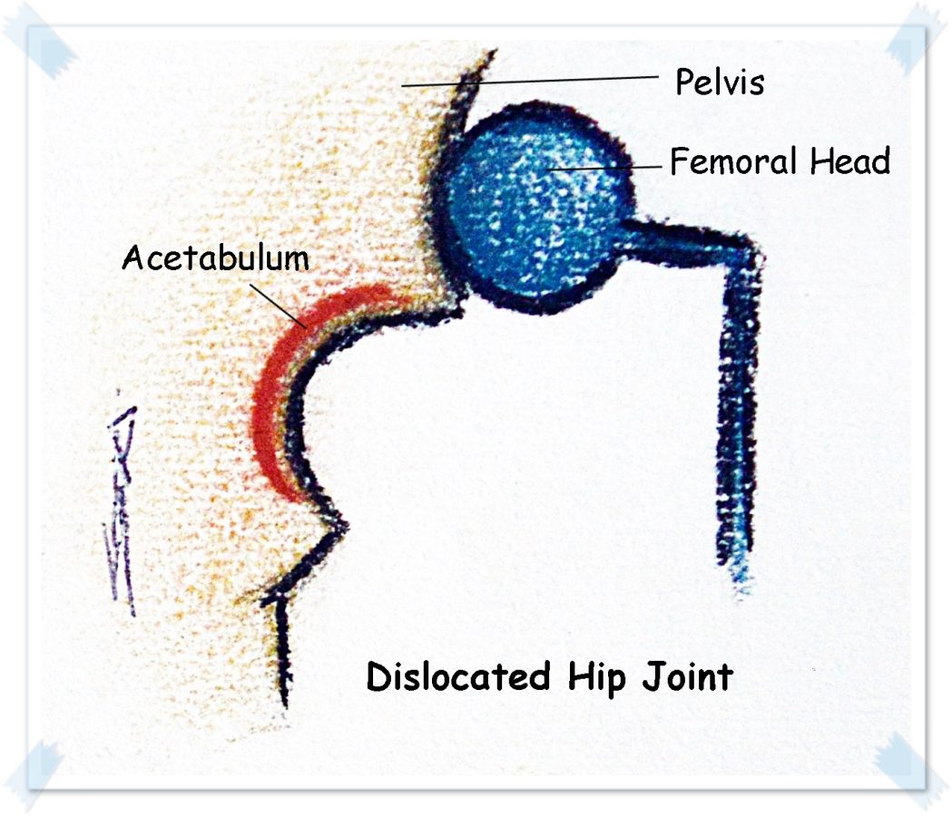 dislocated hip joint new