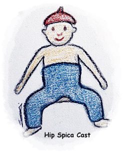 hip spica cast new1