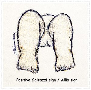 positive galeazzi sign new