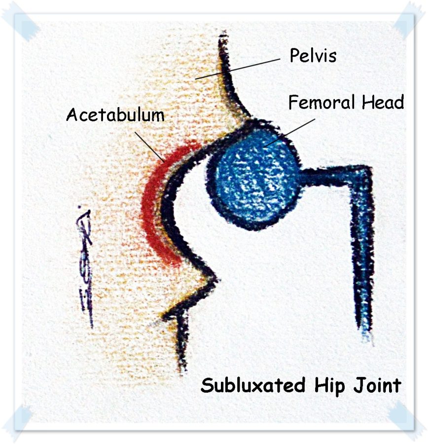 subluxated hip joint new